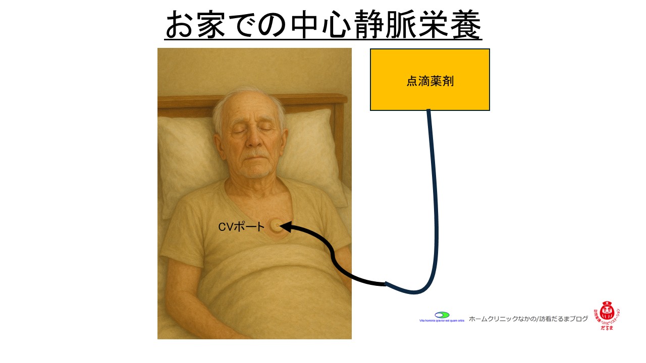 家で中心静脈栄養 | ホームクリニックなかの/訪看だるまブログ